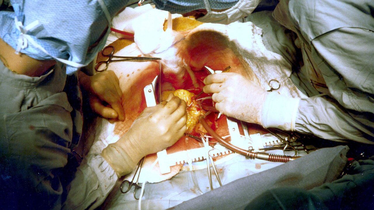 Coronary artery bypass surgery. Image: Wikimedia Commons (File:Coronary artery bypass surgery Image 657B-PH.jpg), Public domain.