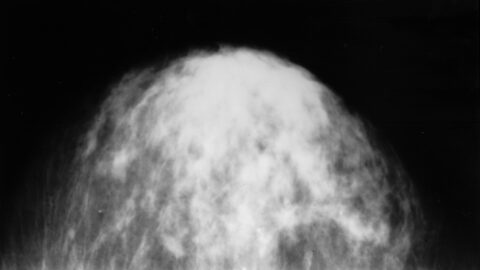 A mammogram image used in cancer screening. Image: Wikimedia Commons (File:Mammogram with subtle cancer.jpg), Public domain. Video: Centers for Disease Control and Prevention (CDC) on YouTube.